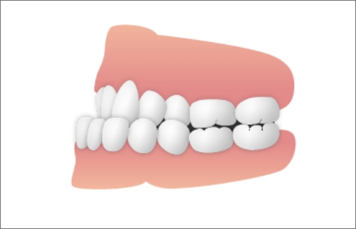 反対咬合（受け口）