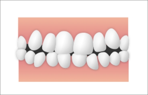 叢生（乱杭歯）